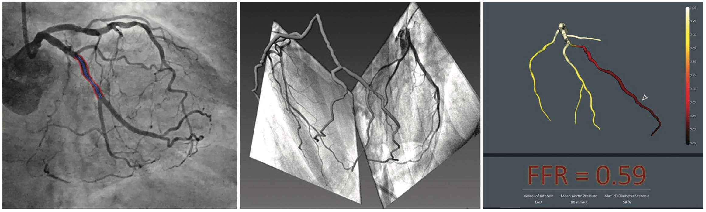Noninvasive AngiographicDerived FFR Is Wireless Physiology Coming to Your Cath Lab Soon?